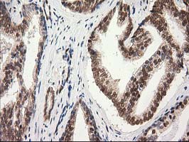 PRKCE / PKC-Epsilon Antibody - IHC of paraffin-embedded Carcinoma of Human prostate tissue using anti-PRKCE mouse monoclonal antibody.