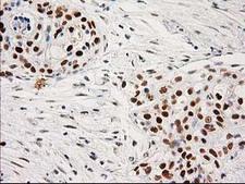 PRKCE / PKC-Epsilon Antibody - IHC of paraffin-embedded Carcinoma of Human pancreas tissue using anti-PRKCE mouse monoclonal antibody. (Heat-induced epitope retrieval by 10mM citric buffer, pH6.0, 100C for 10min).