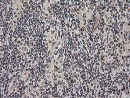 PRKCE / PKC-Epsilon Antibody - IHC of paraffin-embedded Human lymphoma tissue using anti-PRKCE mouse monoclonal antibody. (Heat-induced epitope retrieval by 10mM citric buffer, pH6.0, 100C for 10min).