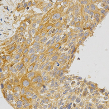 PRKCE / PKC-Epsilon Antibody - Immunohistochemistry of paraffin-embedded human esophageal cancer using PRKCE antibody at dilution of 1:200 (x400 lens)