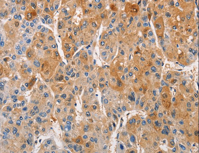 PRKCE / PKC-Epsilon Antibody - Immunohistochemistry of paraffin-embedded Human liver cancer using PRKCE Polyclonal Antibody at dilution of 1:50.