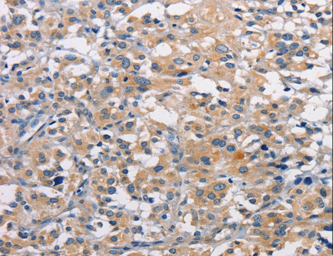 PRKCE / PKC-Epsilon Antibody - Immunohistochemistry of paraffin-embedded Human thyroid cancer using PRKCE Polyclonal Antibody at dilution of 1:50.