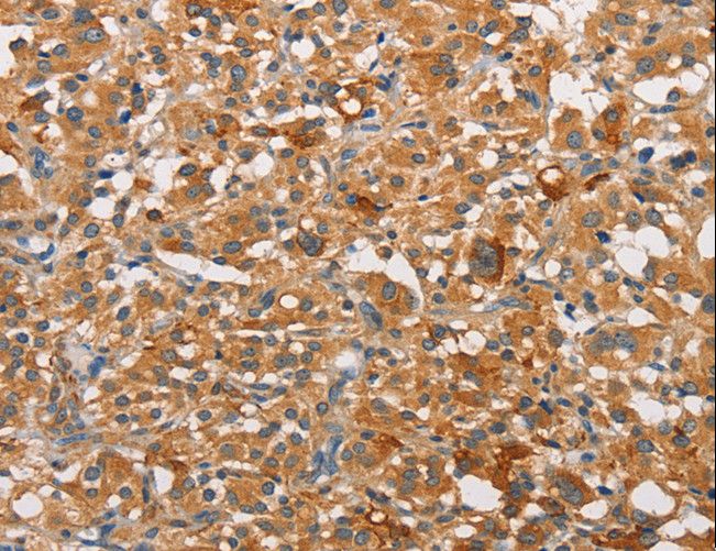 PRKCE / PKC-Epsilon Antibody - Immunohistochemistry of paraffin-embedded Human liver cancer using PRKCE Polyclonal Antibody at dilution of 1:30.
