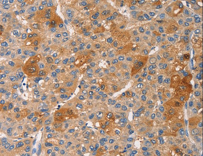 PRKCE / PKC-Epsilon Antibody - Immunohistochemistry of paraffin-embedded Human liver cancer using PRKCE Polyclonal Antibody at dilution of 1:30.