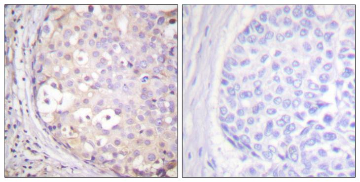 PRKCE / PKC-Epsilon Antibody - Peptide - + Immunohistochemistry analysis of paraffin-embedded human breast carcinoma tissue using PKC-pan (Ab-497) antibody.