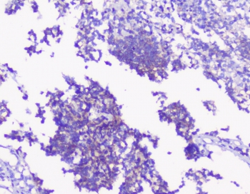 PRKCG / PKC-Gamma Antibody - IHC staining of FFPE human glioma with PKC gamma antibody at 1ug/ml. HIER: boil tissue sections in pH6, 10mM citrate buffer, for 10-20 min followed by cooling at RT for 20 min.