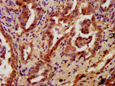 PRKCH / PKC-Eta Antibody - IHC image of PRKCH Antibody diluted at 1:700 and staining in paraffin-embedded human lung cancer performed on a Leica BondTM system. After dewaxing and hydration, antigen retrieval was mediated by high pressure in a citrate buffer (pH 6.0). Section was blocked with 10% normal goat serum 30min at RT. Then primary antibody (1% BSA) was incubated at 4°C overnight. The primary is detected by a biotinylated secondary antibody and visualized using an HRP conjugated SP system.