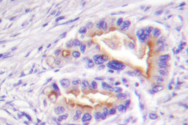 PRKCQ / PKC-Theta Antibody - IHC of PKC (G532) pAb in paraffin-embedded human lung carcinoma tissue.