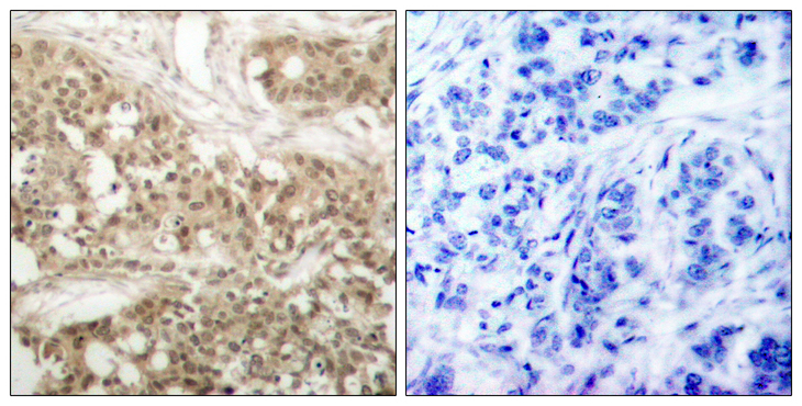 PRKCQ / PKC-Theta Antibody - Immunohistochemistry analysis of paraffin-embedded human breast carcinoma, using PKC thet (Phospho-Ser676) Antibody. The picture on the right is blocked with the phospho peptide.