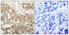 PRKCQ / PKC-Theta Antibody - Immunohistochemistry analysis of paraffin-embedded human breast carcinoma, using PKC thet (Phospho-Ser676) Antibody. The picture on the right is blocked with the phospho peptide.