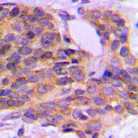 PRKCQ / PKC-Theta Antibody - Immunohistochemical analysis of PKC theta (pS676) staining in human breast cancer formalin fixed paraffin embedded tissue section. The section was pre-treated using heat mediated antigen retrieval with sodium citrate buffer (pH 6.0). The section was then incubated with the antibody at room temperature and detected using an HRP conjugated compact polymer system. DAB was used as the chromogen. The section was then counterstained with hematoxylin and mounted with DPX.