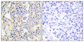 PRKCQ / PKC-Theta Antibody - IHC of paraffin-embedded human breast carcinoma, using PKC theta (Phospho-Ser695) Antibody. The sample on the right was incubated with synthetic peptide.