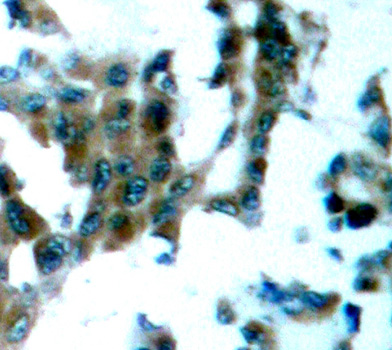 PRKCQ / PKC-Theta Antibody - Immunohistochemical analysis of paraffin-embedded human lung carcinoma tissue.