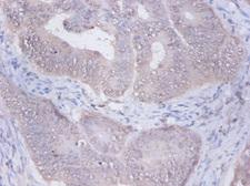 PRKCSH Antibody - Immunohistochemistry of paraffin-embedded human colon cancer using PRKCSH Antibody at dilution of 1:100