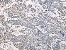 PRKCSH Antibody - Immunohistochemistry of paraffin-embedded Human colorectal cancer tissue  using PRKCSH Polyclonal Antibody at dilution of 1:65(×200)
