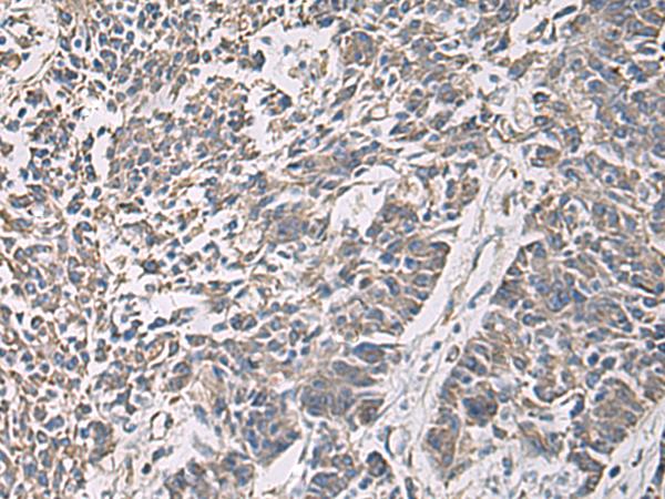 PRKCSH Antibody - Immunohistochemistry of paraffin-embedded Human colorectal cancer tissue  using PRKCSH Polyclonal Antibody at dilution of 1:90(×200)