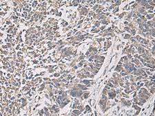 PRKCSH Antibody - Immunohistochemistry of paraffin-embedded Human colorectal cancer tissue  using PRKCSH Polyclonal Antibody at dilution of 1:90(×200)