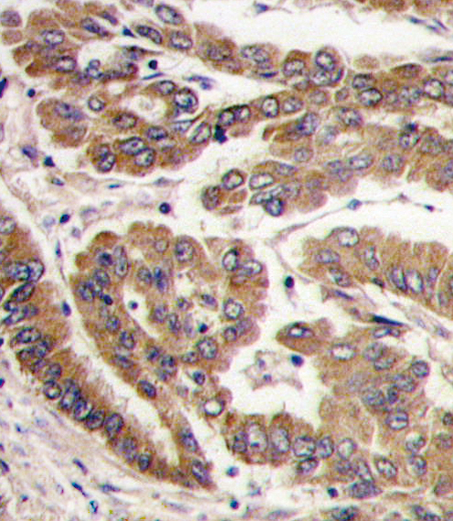 PRKCZ / PKC-Zeta Antibody - Formalin-fixed and paraffin-embedded human lung carcinoma tissue reacted with PKC zeta antibody , which was peroxidase-conjugated to the secondary antibody, followed by DAB staining. This data demonstrates the use of this antibody for immunohistochemistry; clinical relevance has not been evaluated.