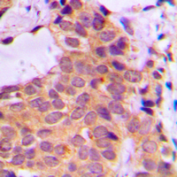 PRKCZ / PKC-Zeta Antibody - Immunohistochemical analysis of PKC zeta staining in human breast cancer formalin fixed paraffin embedded tissue section. The section was pre-treated using heat mediated antigen retrieval with sodium citrate buffer (pH 6.0). The section was then incubated with the antibody at room temperature and detected using an HRP conjugated compact polymer system. DAB was used as the chromogen. The section was then counterstained with hematoxylin and mounted with DPX.