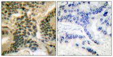 PRKCZ / PKC-Zeta Antibody - Immunohistochemistry analysis of paraffin-embedded human lung carcinoma, using PKC zeta (Phospho-Thr410) Antibody. The picture on the right is blocked with the phospho peptide.