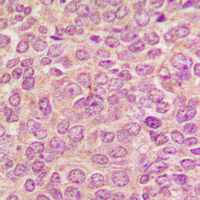 PRKD1 / PKC Mu Antibody - Immunohistochemical analysis of PKC mu staining in human breast cancer formalin fixed paraffin embedded tissue section. The section was pre-treated using heat mediated antigen retrieval with sodium citrate buffer (pH 6.0). The section was then incubated with the antibody at room temperature and detected using an HRP conjugated compact polymer system. DAB was used as the chromogen. The section was then counterstained with hematoxylin and mounted with DPX.