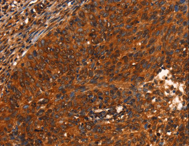PRKD1 / PKC Mu Antibody - Immunohistochemistry of paraffin-embedded Human cervical cancer using PRKD1 Polyclonal Antibody at dilution of 1:40.