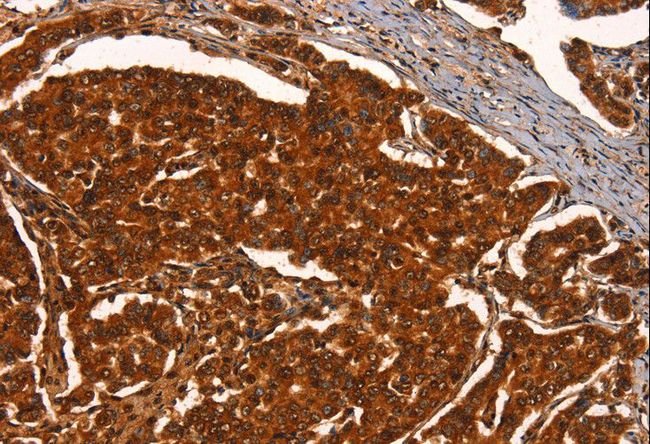 PRKD1 / PKC Mu Antibody - Immunohistochemistry of paraffin-embedded Human breast cancer using PRKD1 Polyclonal Antibody at dilution of 1:40.