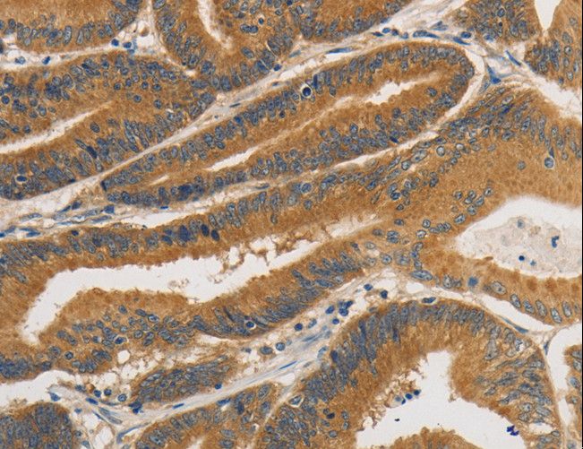 PRKD1 / PKC Mu Antibody - Immunohistochemistry of paraffin-embedded Human liver cancer using PRKD1 Polyclonal Antibody at dilution of 1:30.