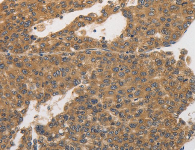 PRKD1 / PKC Mu Antibody - Immunohistochemistry of paraffin-embedded Human liver cancer using PRKD1 Polyclonal Antibody at dilution of 1:30.
