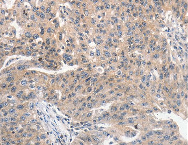 PRKD1 / PKC Mu Antibody - Immunohistochemistry of paraffin-embedded Human ovarian cancer using PRKD1 Polyclonal Antibody at dilution of 1:70.