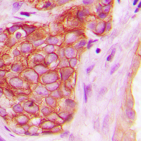 PRKD1 / PKC Mu Antibody - Immunohistochemical analysis of PKC mu (pY463) staining in human breast cancer formalin fixed paraffin embedded tissue section. The section was pre-treated using heat mediated antigen retrieval with sodium citrate buffer (pH 6.0). The section was then incubated with the antibody at room temperature and detected using an HRP-conjugated compact polymer system. DAB was used as the chromogen. The section was then counterstained with hematoxylin and mounted with DPX.