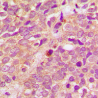 PRKD1 + PRKD2 + PRKD3 Antibody - Immunohistochemical analysis of PRKD1/2/3 (pS738/S742) staining in human breast cancer formalin fixed paraffin embedded tissue section. The section was pre-treated using heat mediated antigen retrieval with sodium citrate buffer (pH 6.0). The section was then incubated with the antibody at room temperature and detected using an HRP conjugated compact polymer system. DAB was used as the chromogen. The section was then counterstained with hematoxylin and mounted with DPX.