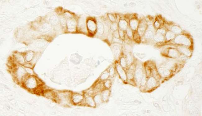 PRKD2 / PKD2 Antibody - Detection of Human PKD2 by Immunohistochemistry. Sample: FFPE section of human stomach carcinoma. Antibody: Affinity purified rabbit anti-PKD1 used at a dilution of 1:1000 (1 ug/ml). Detection: DAB.