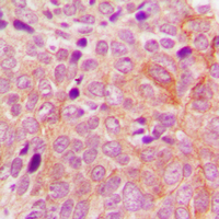 PRKD2 / PKD2 Antibody - Immunohistochemical analysis of PRKD2 staining in human breast cancer formalin fixed paraffin embedded tissue section. The section was pre-treated using heat mediated antigen retrieval with sodium citrate buffer (pH 6.0). The section was then incubated with the antibody at room temperature and detected using an HRP conjugated compact polymer system. DAB was used as the chromogen. The section was then counterstained with hematoxylin and mounted with DPX.