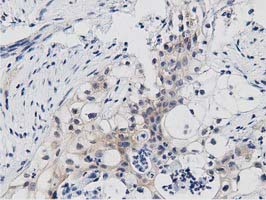PRKD2 / PKD2 Antibody - IHC of paraffin-embedded Carcinoma of Human pancreas tissue using anti-PRKD2 mouse monoclonal antibody. (Dilution 1:50).