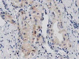 PRKD2 / PKD2 Antibody - IHC of paraffin-embedded Carcinoma of Human thyroid tissue using anti-PRKD2 mouse monoclonal antibody. (Dilution 1:50).