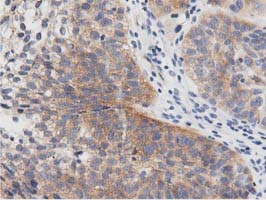 PRKD2 / PKD2 Antibody - IHC of paraffin-embedded Carcinoma of Human bladder tissue using anti-PRKD2 mouse monoclonal antibody. (Dilution 1:50).