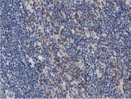 PRKD2 / PKD2 Antibody - IHC of paraffin-embedded Human lymphoma tissue using anti-PRKD2 mouse monoclonal antibody. (Dilution 1:50).