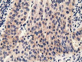 PRKD2 / PKD2 Antibody - IHC of paraffin-embedded Carcinoma of Human bladder tissue using anti-PRKD2 mouse monoclonal antibody.