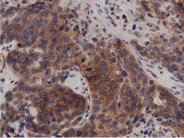 PRKD2 / PKD2 Antibody - Immunohistochemical staining of paraffin-embedded Adenocarcinoma of Human ovary tissue using anti-PRKD2 mouse monoclonal antibody. (Dilution 1:50).