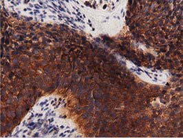 PRKD2 / PKD2 Antibody - Immunohistochemical staining of paraffin-embedded Carcinoma of Human bladder tissue using anti-PRKD2 mouse monoclonal antibody. (Dilution 1:50).