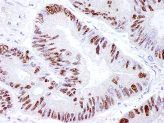PRKDC / DNA-PKcs Antibody - Detection of Human DNA-PKcs by Immunohistochemistry. Sample: FFPE section of human lung adenocarcinoma. Antibody: Affinity purified rabbit anti-DNA-PKcs used at a dilution of 1:250. Detection: DAB.