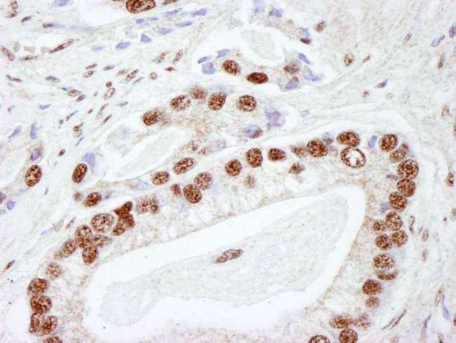 PRKDC / DNA-PKcs Antibody - Detection of Human DNA-PKcs by Immunohistochemistry. Sample: FFPE section of prostate adenocarcinoma. Antibody: Affinity purified rabbit anti-DNA-PKcs used at a dilution of 1:250. Detection: DAB.