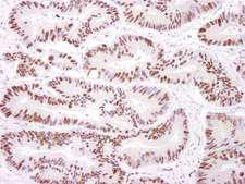 PRKDC / DNA-PKcs Antibody - Detection of Human DNA-PKcs by Immunohistochemistry. Sample: FFPE section of human lung carcinoma. Antibody: Affinity purified rabbit anti-DNA-PKcs used at a dilution of 1:200 (1 ug/ml). Detection: DAB.