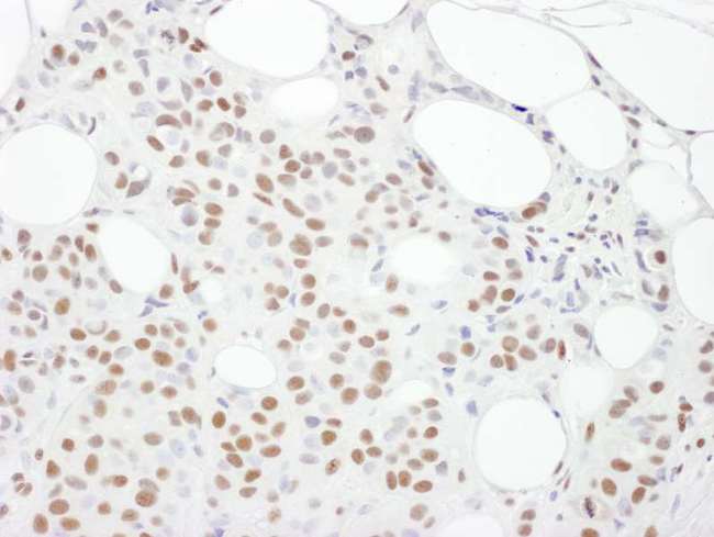 PRKDC / DNA-PKcs Antibody - Detection of Human DNA-PKcs by Immunohistochemistry. Sample: FFPE section of human breast carcinoma. Antibody: Affinity purified rabbit anti-DNA-PKcs used at a dilution of 1:5000 (0.2 ug/ml). Detection: DAB.