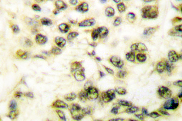 PRKDC / DNA-PKcs Antibody - IHC of DNA-PKCS (R4090) pAb in paraffin-embedded human breast carcinoma tissue.