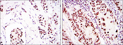 PRKDC / DNA-PKcs Antibody - IHC of paraffin-embedded breast cancer (left) and colon cancer (right) using PRKDC mouse monoclonal antibody with DAB staining.