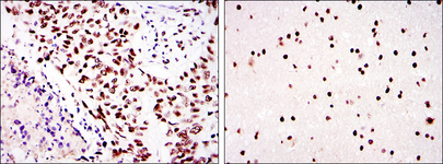 PRKDC / DNA-PKcs Antibody - IHC of paraffin-embedded lung cancer (left) and brain tissues (right) using PRKDC mouse monoclonal antibody with DAB staining.