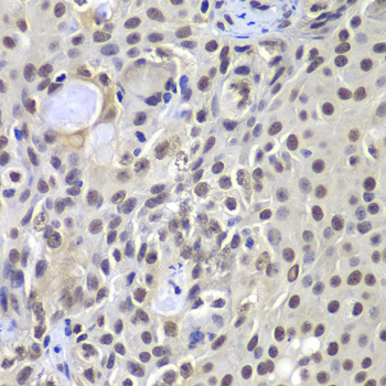 PRKDC / DNA-PKcs Antibody - Immunohistochemistry of paraffin-embedded human well-differentiated squamous skin carcinoma tissue.