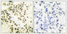 PRKDC / DNA-PKcs Antibody - Peptide - + Immunohistochemical analysis of paraffin-embedded human breast carcinoma tissue using DNA-PK antibody.